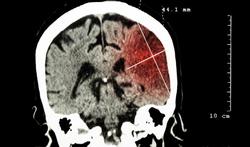 123-anatom-CT-scan-beroerte-hersenbloed-05-17.jpg