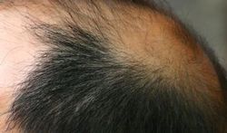 123-man-kaal-hoofd-haar-zijkant-170_08.jpg