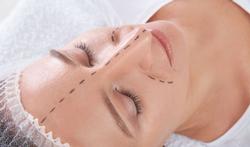 123-neusop-plast-chir-rhinoplastie-02-19.jpg