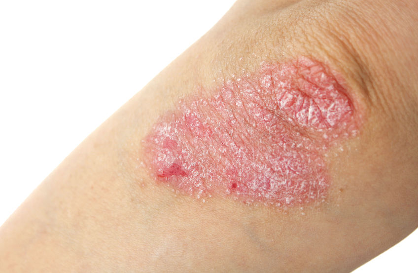 123-psoriasis-elleboog-10-18.png