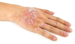 123-psoriasis-hand-10-18.png
