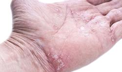 123-psoriasis-hand-12-17.jpg