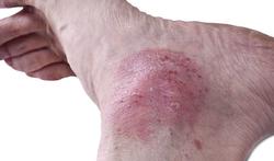 123-psoriasis-voet-12-17.jpg