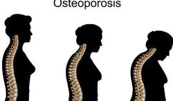 Fotolia_3vr-osteoporsosis-31-15.jpg