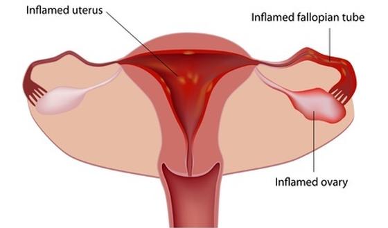 Pijn In De Onderbuik Door Een Eileiderontsteking Salpingitis Of Bekkenontsteking Pid Gezondheid Be