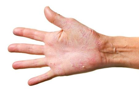 ad_drogehandensymptomen.jpg