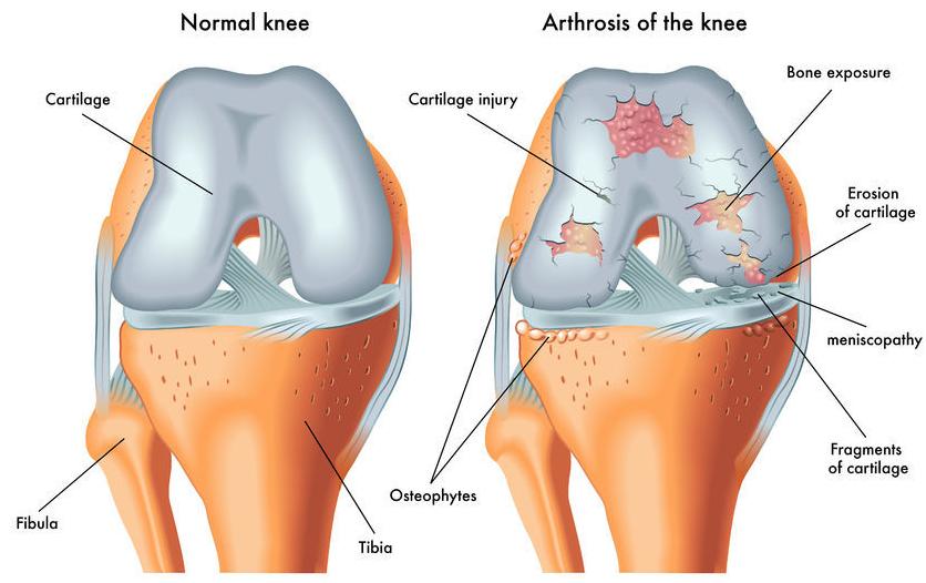 f-123-arthrose-knie-10-17.jpg