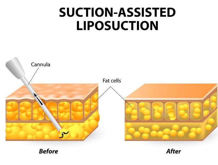 f-123-liposuct-plast-chir-03-18.jpg