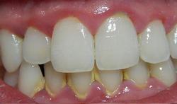 free-Gingivitis-10-15.jpg