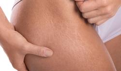 striemen_bil_striae.jpg
