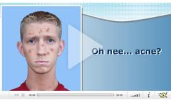 video-acne-expl.jpg