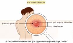 video-huidkanker2-youtube.jpg