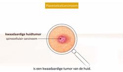 video-huidkanker3-youtube.jpg