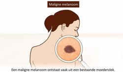 video-huidkanker4-youtube.jpg
