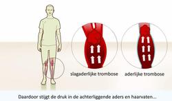 video-trombosebeen-youtube.jpg