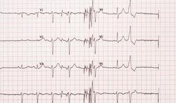 123-EKG-extrasystoles-09-18.jpg