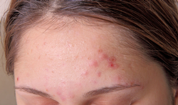 123-acne-voorhoofd-10-18.png