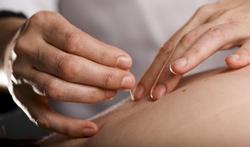Dry needling : c'est quoi et quelle différence avec l'acupuncture ?