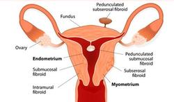 Myomen, vleesbomen, fibromen: goedaardige gezwellen in de baarmoederwand