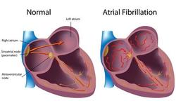 Voorkamer- of atriumfibrillatie: de meest voorkomende hartritmestoornis