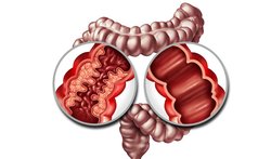 Ziekte van Crohn en colitis ulcerosa