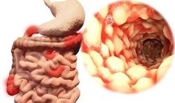 Test jezelf: Heb ik de ziekte van Crohn?