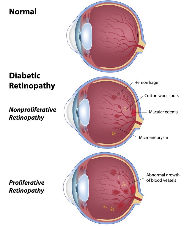 123-anatom-diab-retinopath-01-19.png