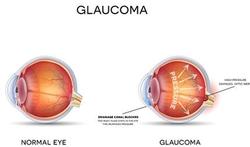 Kan je glaucoom preventief laten opsporen?
