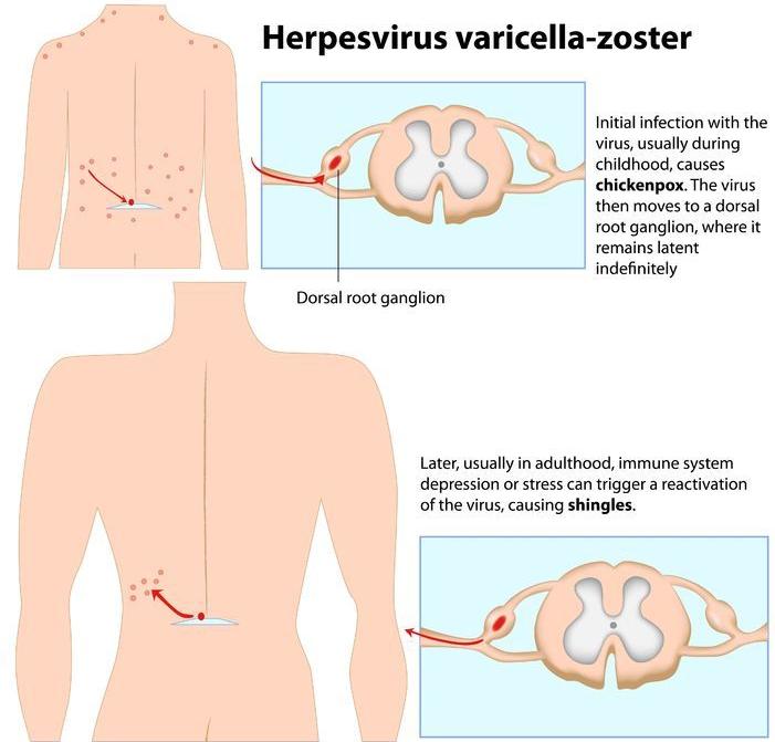 Stress herpes Identify Herpes