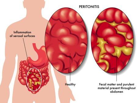 Buikvliesontsteking Of Peritonitis | Gezondheid.Be