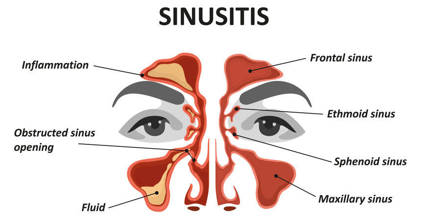 123-anatom-sinusitis-03-19.png