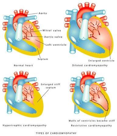 123-anatom-soorten-cardiomyopathie-06-16.jpg