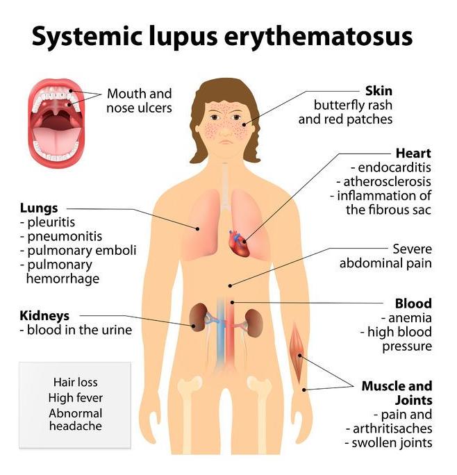 123-anatom-syst-lupus-erythemat-04-18.jpg