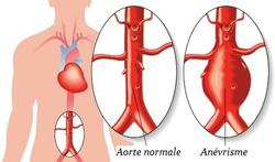 Anévrisme de l'aorte abdominale : qui est à risque ?