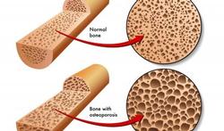 Doorbraak in osteoporosebehandeling bij de man