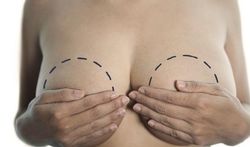 Meer weten over borstamputatie (mastectomie) en borstreconstructie