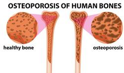 Nieuwe richtlijnen osteoporose