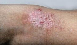 Allergie de la peau : un point pour l’acupuncture 