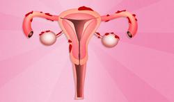 Wat zijn de symptomen van endometriose?