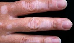 Vitiligo : les causes et les traitements