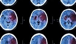 Hoe herken je hersenkanker en wat zijn risicofactoren?