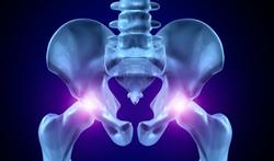 Arthrose de la hanche : le mystère de la douleur