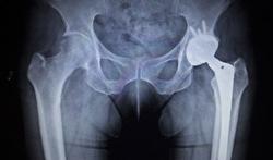 Prothèse de hanche : quel risque de luxation ?