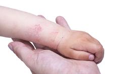 123-kind-eczema-arm-01-18.jpg