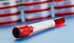 Cholestérol : faut-il être à jeun pour la prise de sang ?