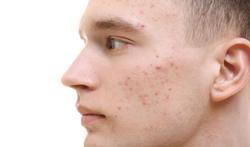 123-man-acne-huid-09-19.jpg