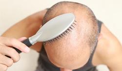 123-man-borstel-haar-kaal-alopecia-10-18.jpg