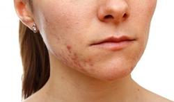 Kan voeding acne uitlokken of verergeren?