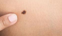 Cancer de la peau : comment reconnaître les symptômes ?