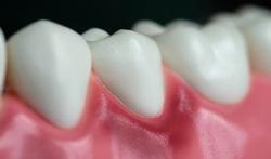 123-mond-tanden-gingivitis-1-25.jpg